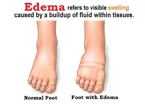 Pitting Vs Non Pitting Edema - BrileyanceRosales