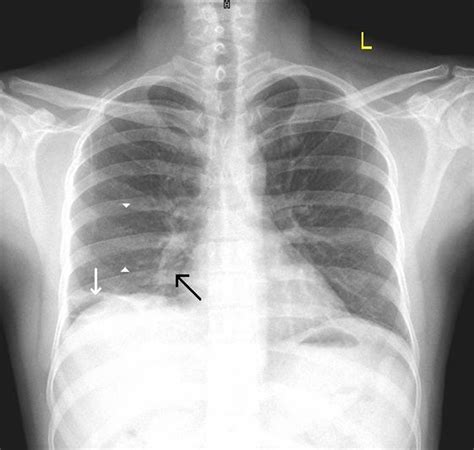 Hampton’s hump, Westermark’s sign and Palla’s sign in acute pulmonary ...