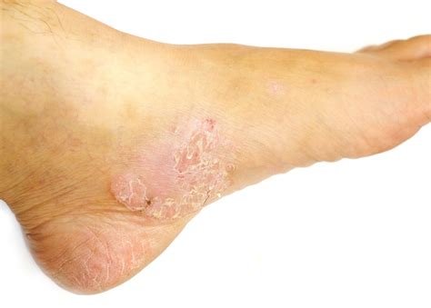 4 Common Foot Skin Problems & Treatments - Foot and Ankle Group