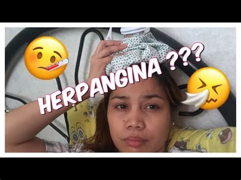 HERPANGINA?? SYMPTOMS AND TREATMENT - YouTube