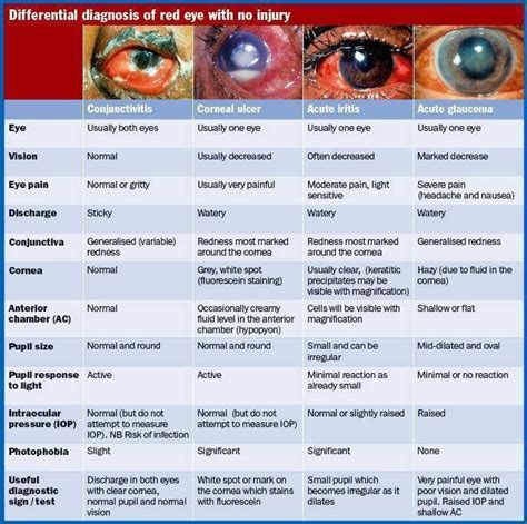 The 25+ best Red eye disease ideas on Pinterest | Red dye image, Red ...