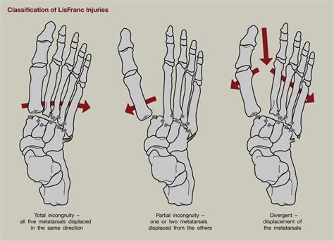 The Pediatric Foot and Ankle - Pediatric Clinics