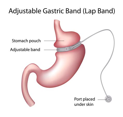 Laparoscopic Adjustable Gastric Banding | Dr. Edward Oliveros