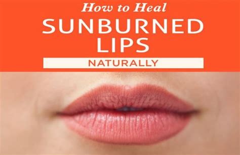 15 Home Remedies To Help You Alleviate Discomfort Caused By Sunburnt Lips