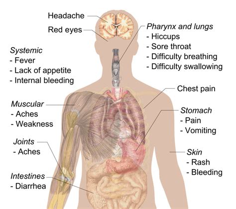 Marburg Symptoms