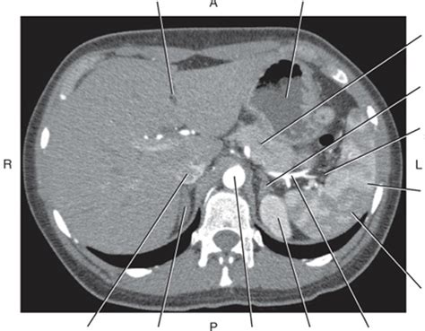 CT spleen Diagram | Quizlet