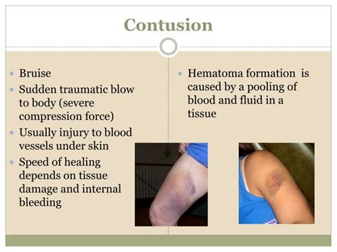 PPT - SPORTS INJURIES PowerPoint Presentation - ID:1596226