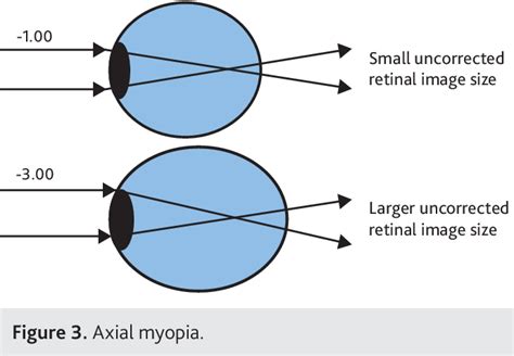 Figure 3 from Anisometropia: what difference does it make? | Semantic ...