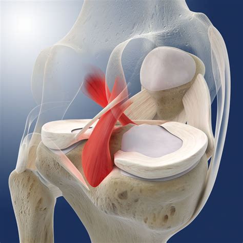 How to Treat the Painful Injury of a Posterior Cruciate Ligament Tear | Cruciate ligament ...