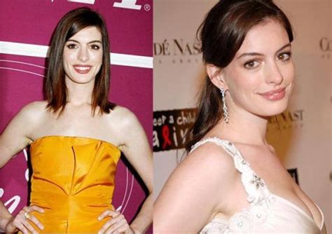 Anne Hathaway's Plastic Surgery Before and After