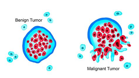 Chapter 13: Cancer – Introduction to Health (OER)