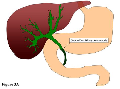 Liver Transplantation and Endoscopic Management of Bile Duct Complications | IntechOpen