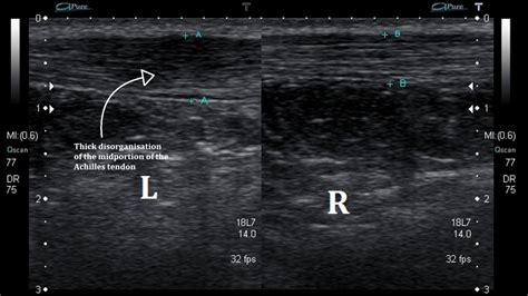 Ultrasound Images of Achilles Tendinopathy - Ankle, Foot and Orthotic Centre