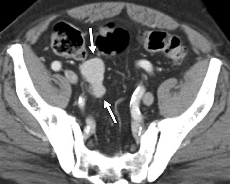 CT of Splenosis: Patterns and Pitfalls | AJR