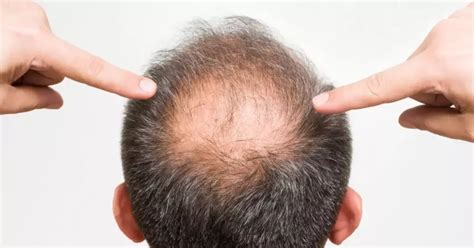 Understanding Hair Miniaturization: Causes, Signs, and Treatment Options