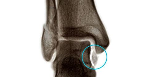 Ankle Avulsion Fracture - Symptoms, Causes & Treatment