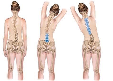 Lumbar Scoliosis Treatment