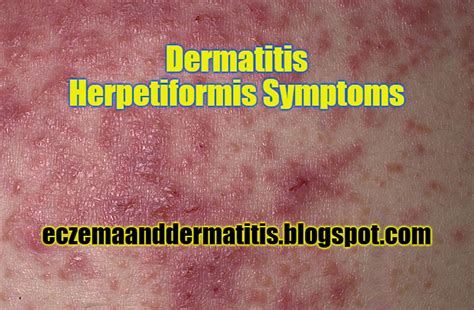 Dermatitis Herpetiformis Symptoms - Eczema and Dermatitis