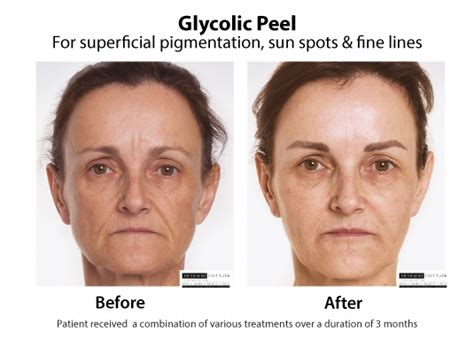 Glycolic Peel | Glycolic Acid | Skin Renewal