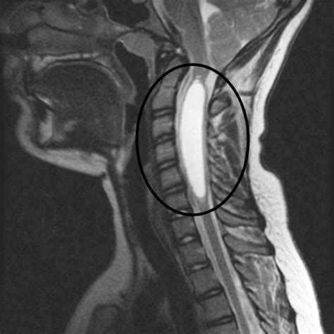 Syringomyelia - Stepwards