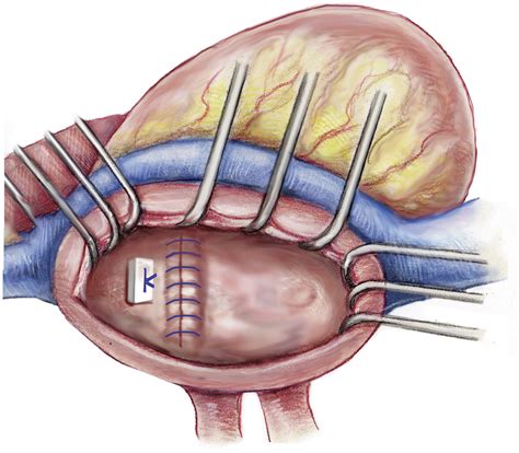 Modified internal ligation of the left atrial appendage - The Journal of Thoracic and ...