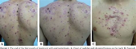 Figure 1 from Pseudo-acne fulminans associated with oral isotretinoin ...