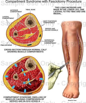 My Experience with Chronic Exertional Compartment Syndrome: Fasciotomy ...