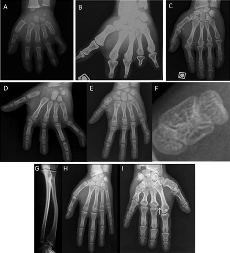 Different types of brachydactyly. (A) Type A1 brachydactyly. Note the ...