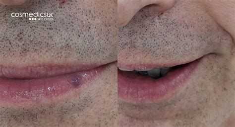 Venous Lake Blood Blister Lip Treatment | London Vein Centre