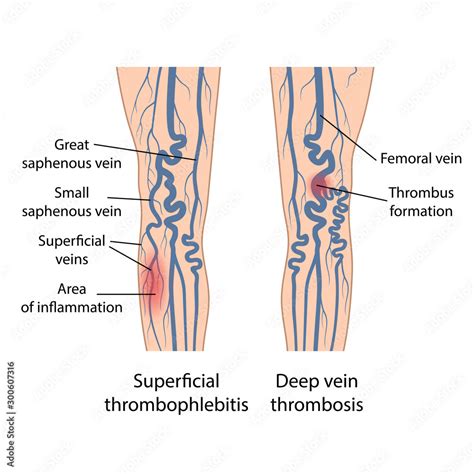 Superficial thrombophlebitis of legs. Deep vein thrombosis. Image of diseased legs. Vector ...