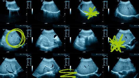 Abnormal results for liver ultrasound: what can they mean?