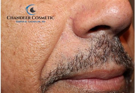 66 Year-Old Man Mole Removal From Cheek - Chandler Cosmetic