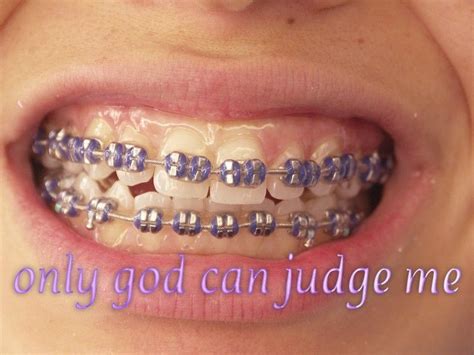 Pin by 今年十八再问自杀 on æ | Braces colors, Dental braces, Cute braces