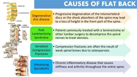 Flat back syndrome