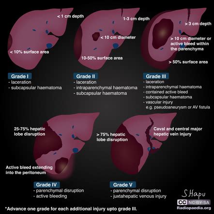 Liver Trauma Grading