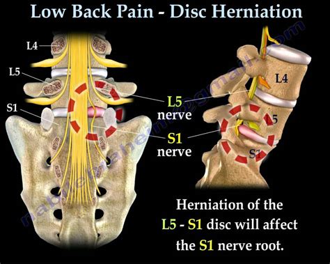 Low Back Pain - Disc Herniation ,Sciatica - Everything You Need To Know - Dr. Nabil Ebraheim ...