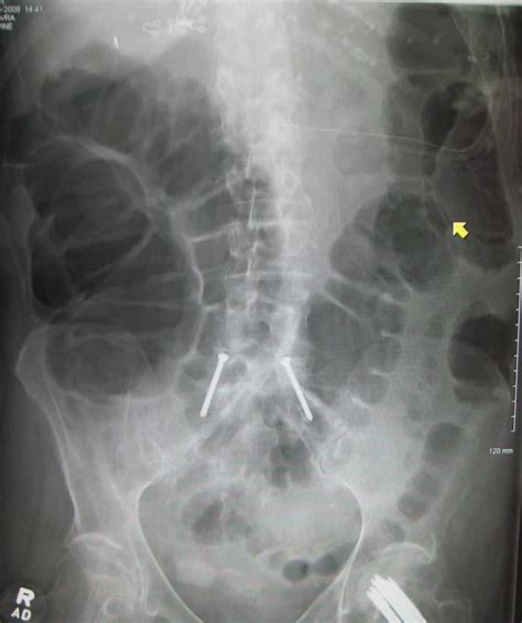 Large Bowel Obstruction - almostadoctor