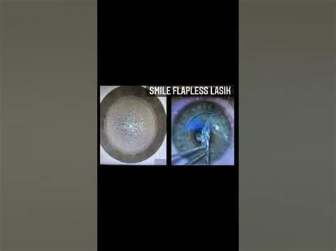 Smile Flapless Lasik at Toyos Clinic Explained - YouTube