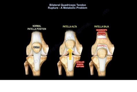 Bilateral Quadriceps Tendon Rupture — OrthopaedicPrinciples.com