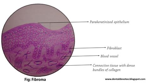 Dentosphere : World of Dentistry: Oral Pathology Histopathological Diagrams - All in one ...