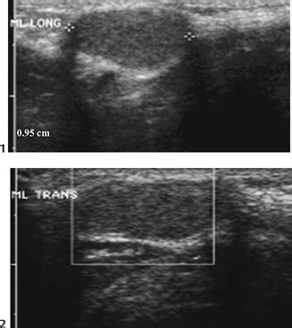 22 Thyroglossal Duct Cyst | Radiology Key