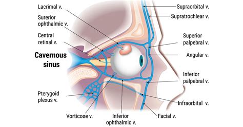 Nursing Considerations For Cavernous Sinus Thrombosis - Ask The Nurse ...