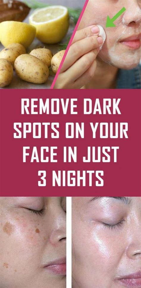 Remove Dark Spots on Your Face in just 3 Nights #Facemasks | Remove dark spots, Health, Spots on ...