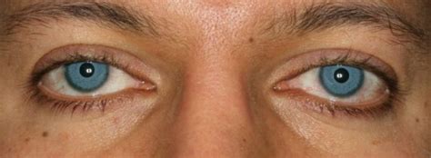 Eye Color Surgery-Just say no. Now updated. - Dr. Kenneth Steinsapir, M.D.