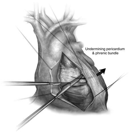 Pericardiectomy for Chronic Constrictive Pericarditis via Left Anterolateral Thoracotomy ...