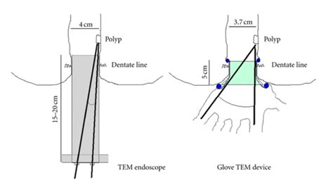 Traditional TEM endoscope versus Glove TEM device: dimensions and... | Download Scientific Diagram