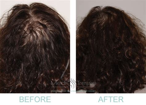 Low Level Laser Therapy For Hair Loss Wellesley & Boston, MA - Medi Tresse