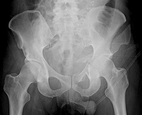 Pelvic Fracture X Ray