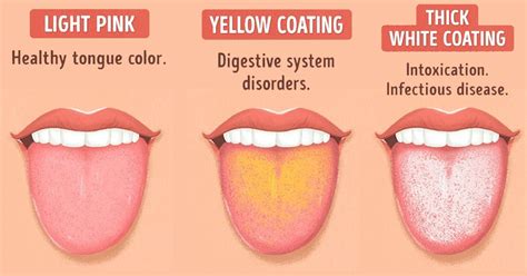 Warnings Your Tongue Is Trying To Tell You About Your Health