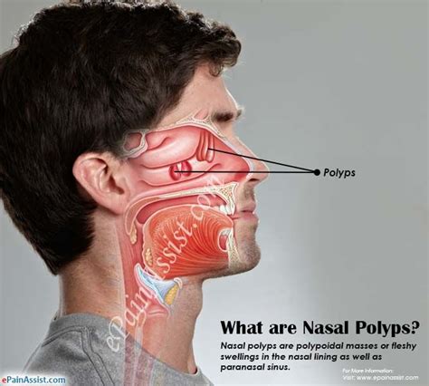 What are Nasal Polyps, Know its Causes, Symptoms, Treatment # ...